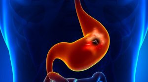 Enfermedades gastrointestinales