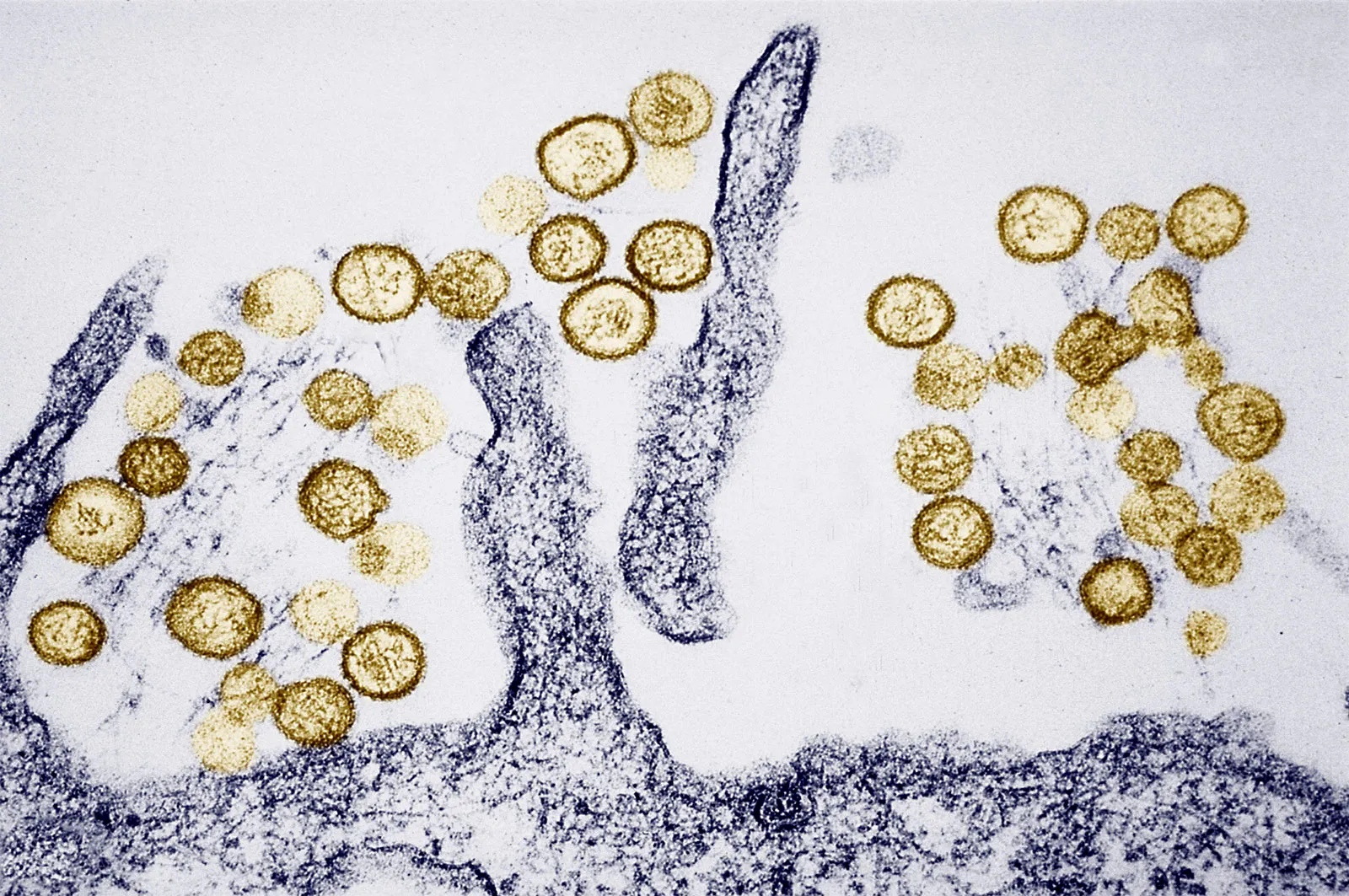Riesgo y prevención del hantavirus global